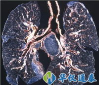你知道什么是塵肺病嗎？使用粉塵儀可以降低塵肺病的發(fā)生率